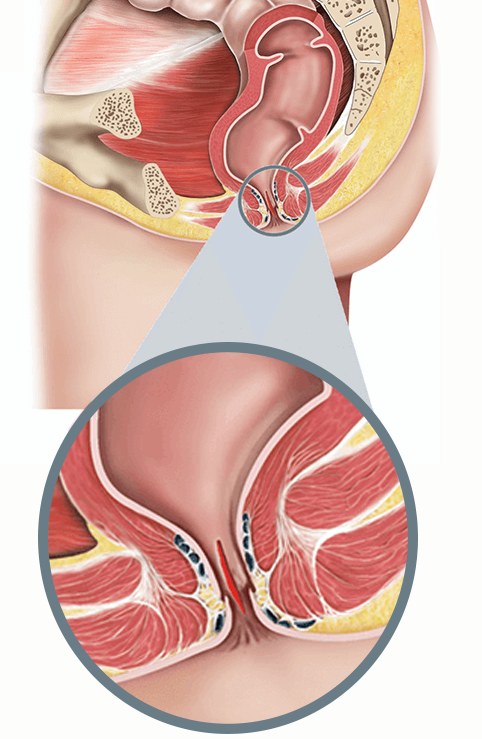 Illustration of the rectum and anus showing an anal fissure (a small tear in the lining), with a magnified close‑up highlighting the fissure.