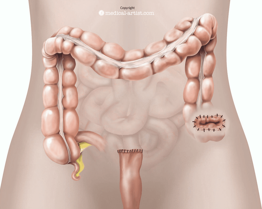 Illustration of the abdominal area after Hartmann’s procedure, showing part of the large bowel removed, a colostomy opening and the rectal stump closed.