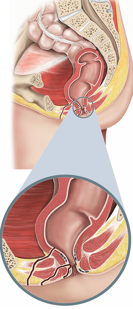 Anal treatment procedure