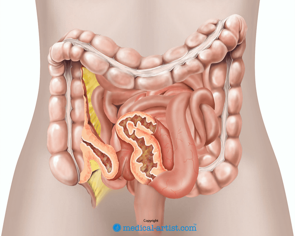 Illustration of Crohn’s disease showing inflammation and thickened walls in the small bowel.