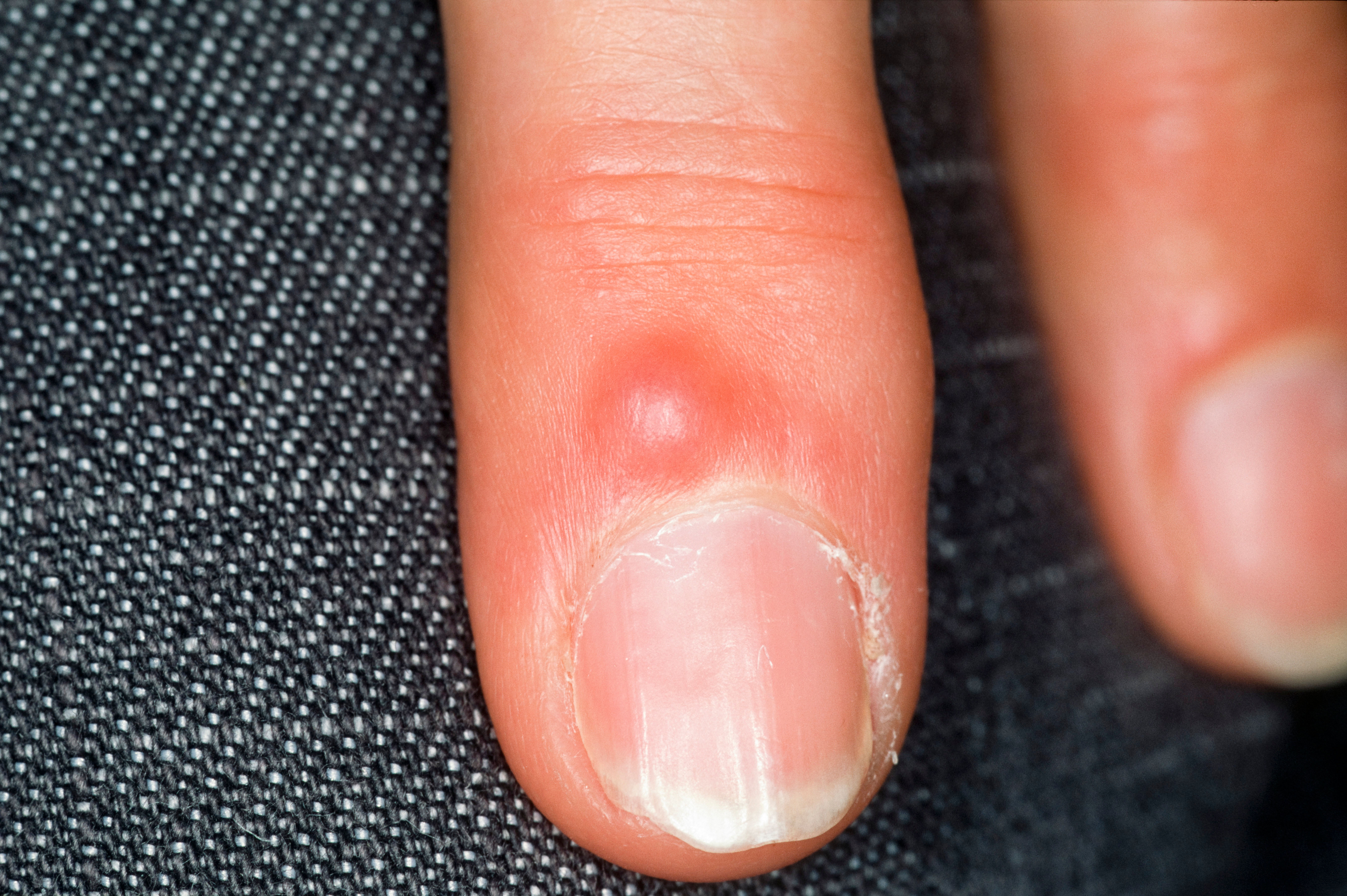 Close-up photo of a cyst located on the final joint of a finger, near the nail bed.