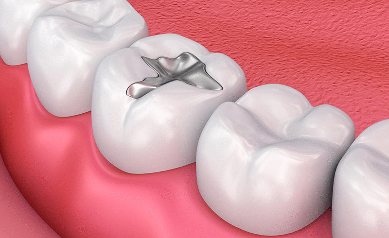 dental fillings