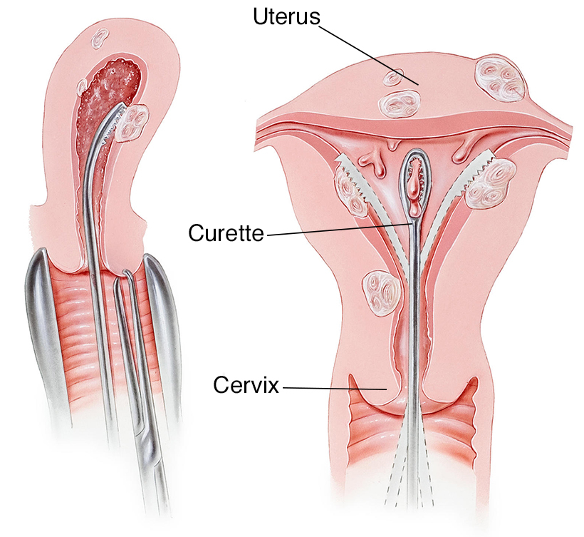 Dilatation And Curettage Healthdirect