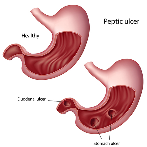 duodenal ulcer pain location