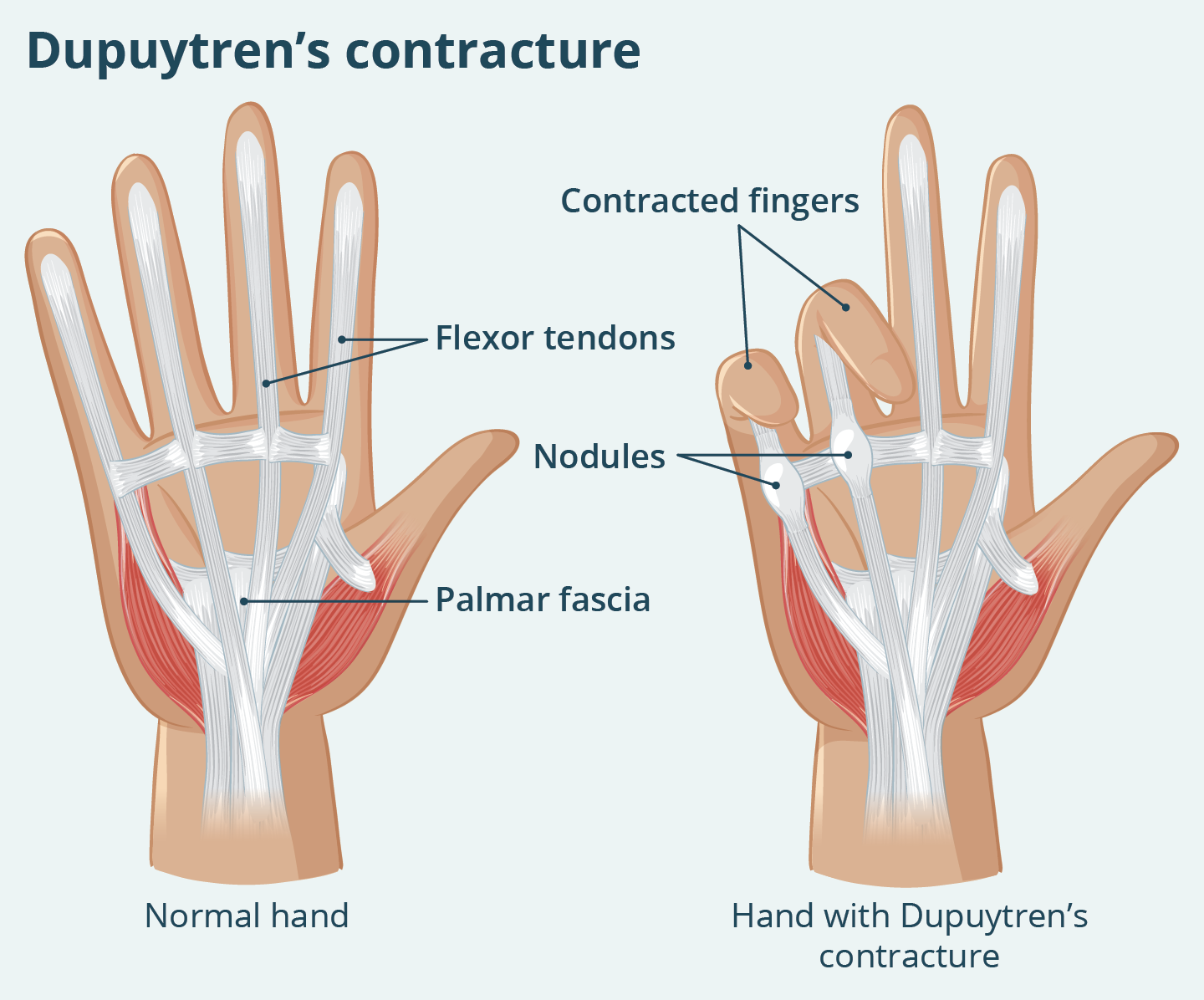 Illustration of Dupuytren’s contracture showing thickened nodules in the palm under the ring and little fingers, causing these fingers to bend toward the palm.