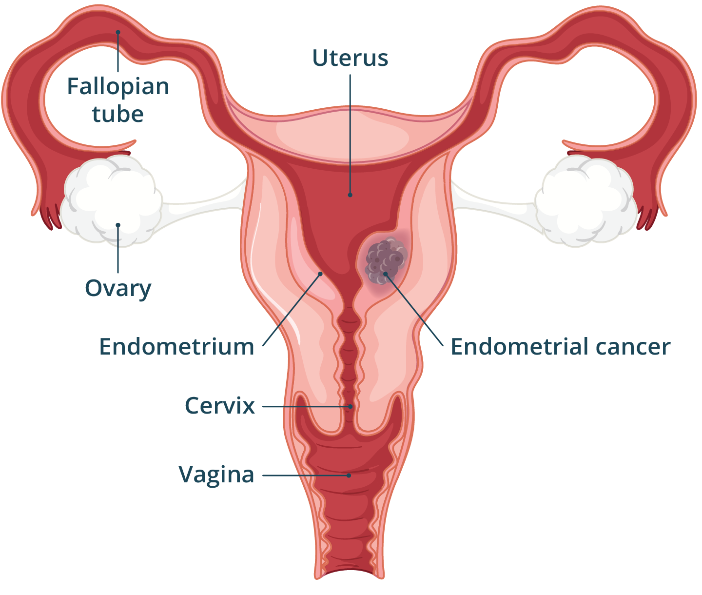 Illustration of the female reproductive system with cancerous mass growing in the lining of the uterus.