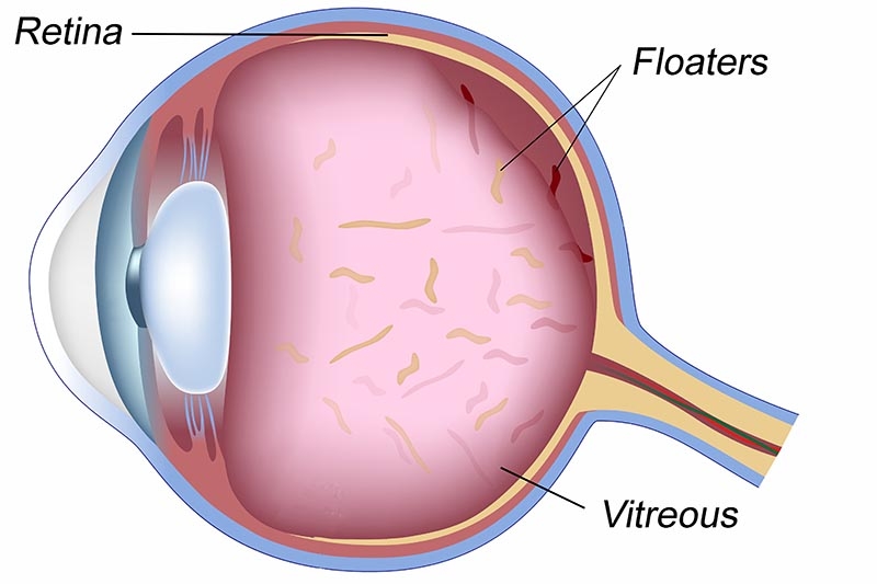 Eye Floaters Symptoms Causes And Treatment Healthdirect