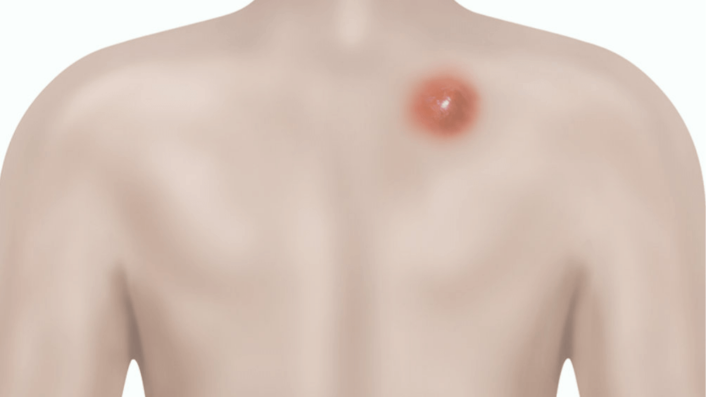 I have developed an open sore under my left breast that continues to open  at the scar line? (Photo)