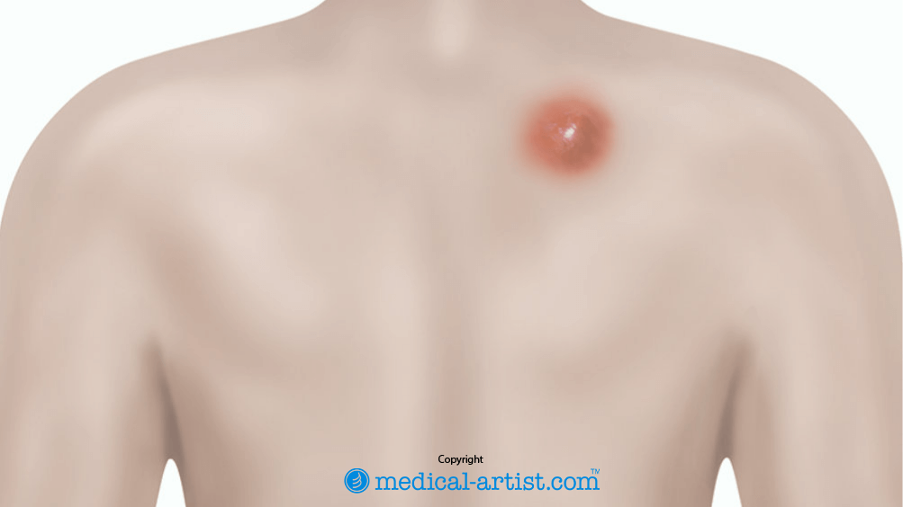 Illustration showing an abscess.