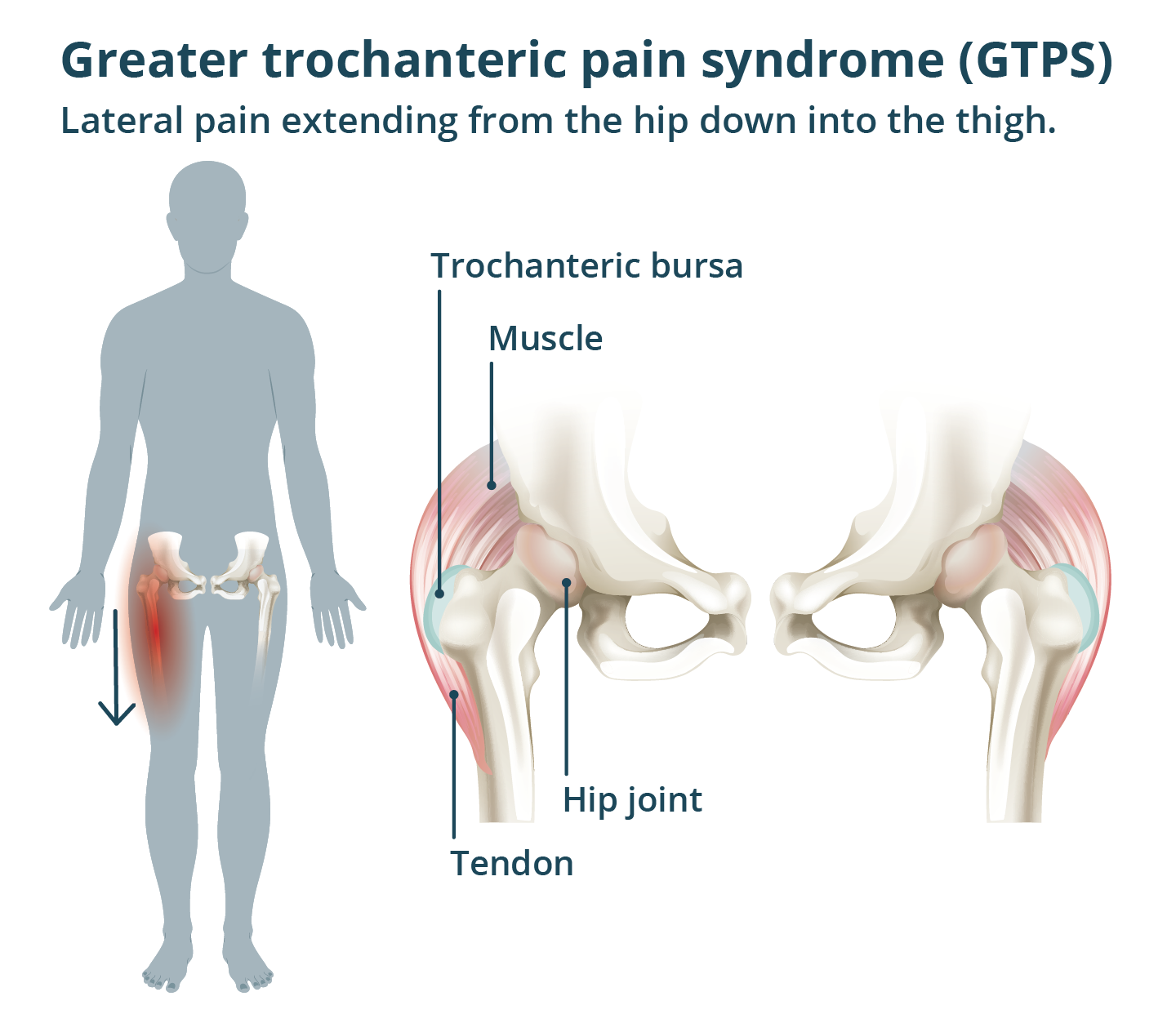 Greater trochanteric pain syndrome (GTPS) Illustration of GTPS pain starting in the hip moving down the thigh and the related muscles and bones.