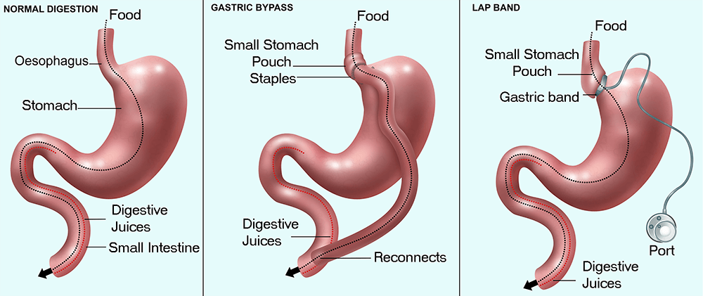 Excess skin problems among adolescents after bariatric surgery