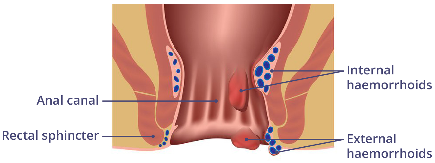 Haemorrhoids (piles) during pregnancy Illustration showing internal and external haemorrhoids.