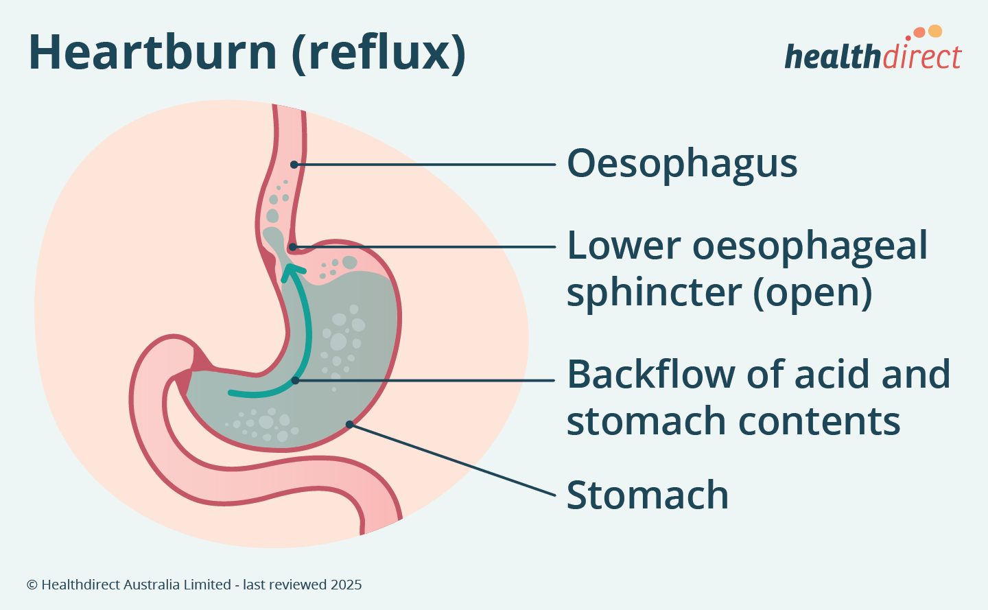 Illustration of the stomach showing how heartburn is caused: backflow of stomach acid and contents through an open lower oesophageal sphincter into the oesophagus.