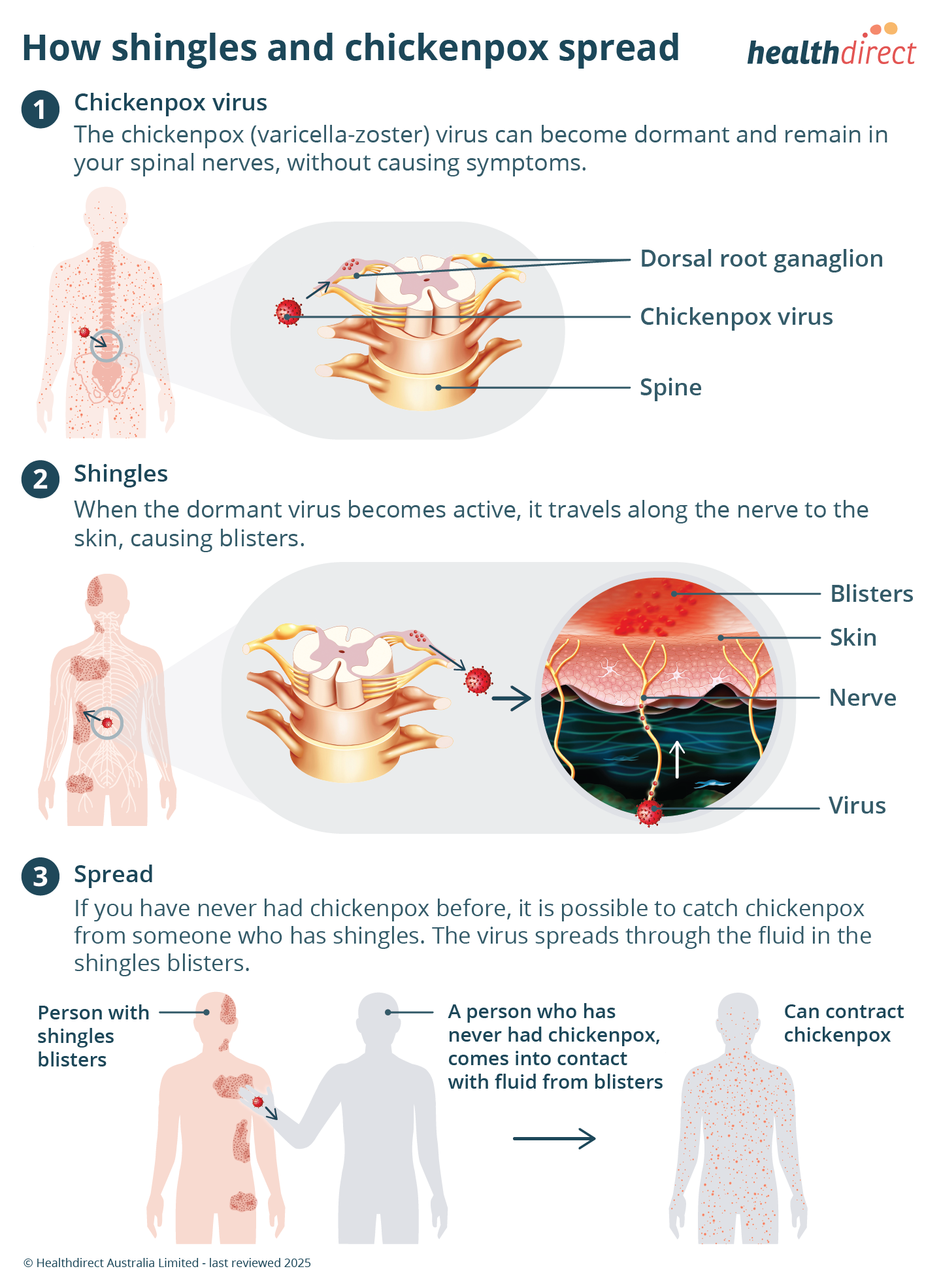 How shingles and chickenpox spread - Diagram Diagram showing how chickenpox can become shingles and how shingles can spread chickenpox.