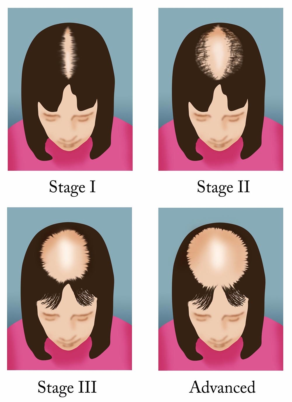 Illustration of the four stages of female pattern hair loss