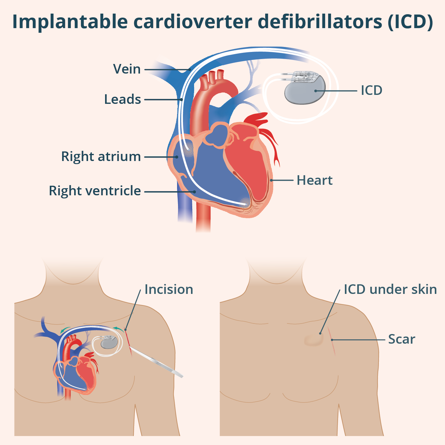 Illustration showing an implantable cardioverter defibrillator (ICD) placed under the skin in the chest, with thin leads running through blood vessels into the heart.