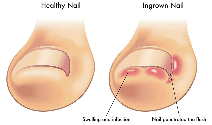 Causes and Treatments of Ingrown Toenails - Your Foot Clinic