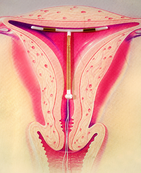 Image of an illustration of a uterus with a IUD sitting on top, showing where it will sit after insertion.