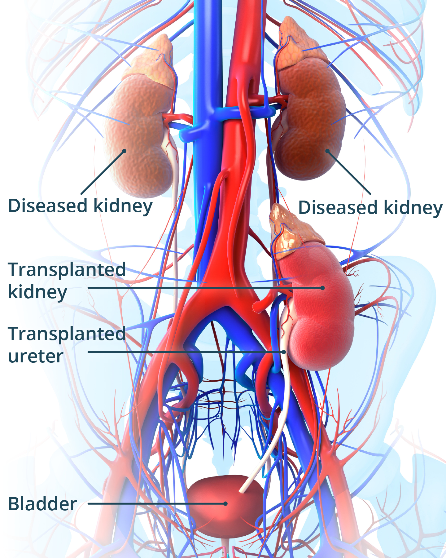 Illustration of a transplanted kidney showing the old kidneys, the transplanted kidney, the ueter and the bladder