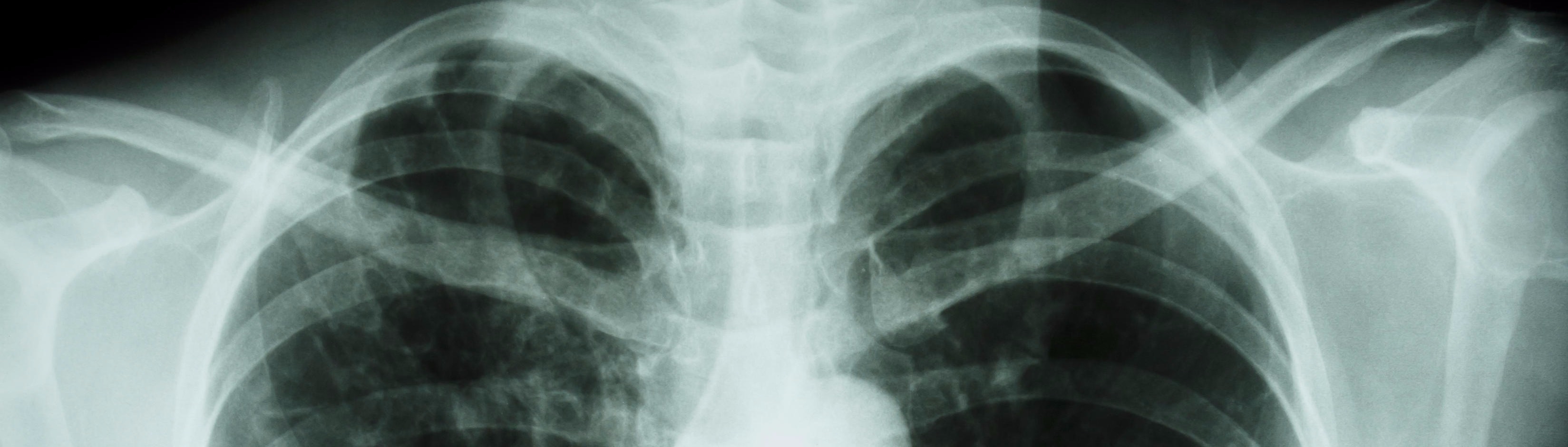 Lung x-ray Lung x-ray