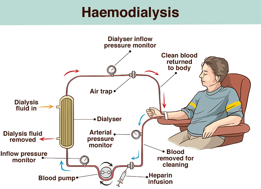 Illustration showing how a haemodialysis works.