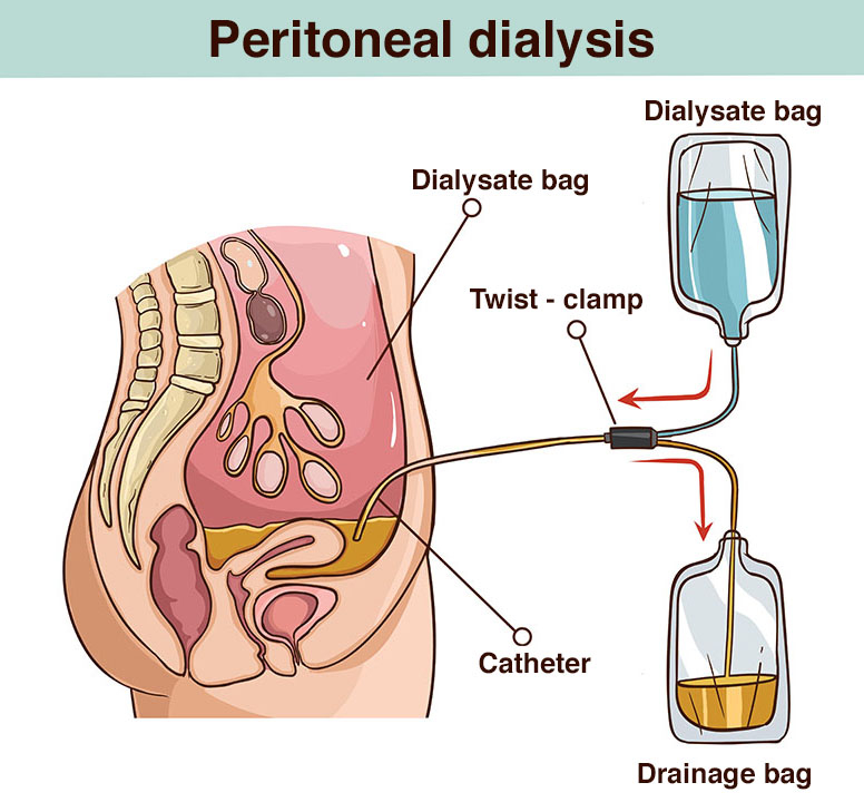 Illustration showing how a peritoneal dialysis works.