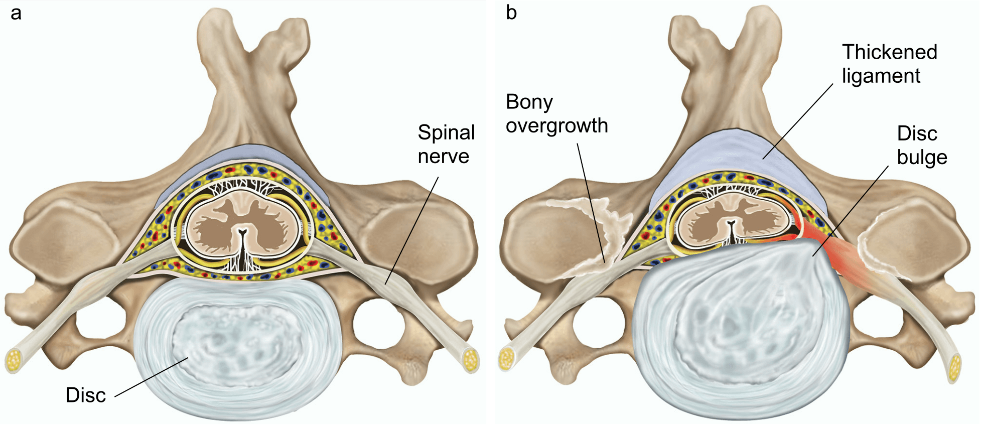 Illustration of a spinal canal and disc