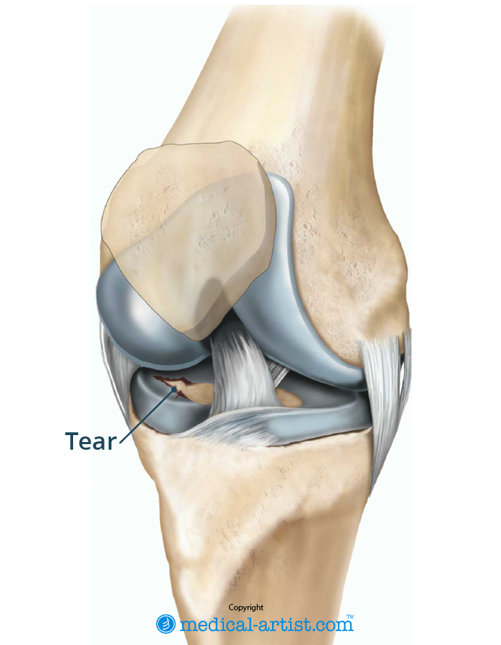 Illustration of a knee with a tear in the lateral meniscus.
