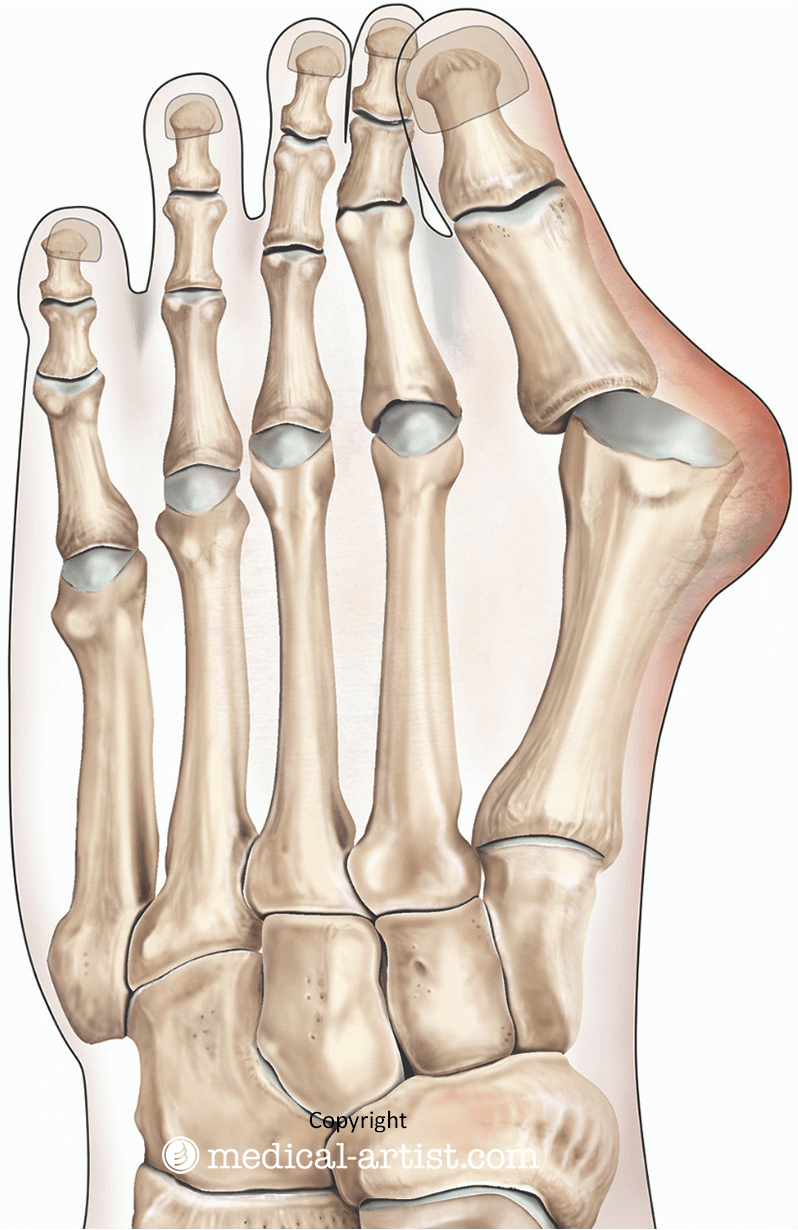 Illustration of the outline and bones of a left foot, showing the big toe angled toward the other toes and a bunion formed on the joint.