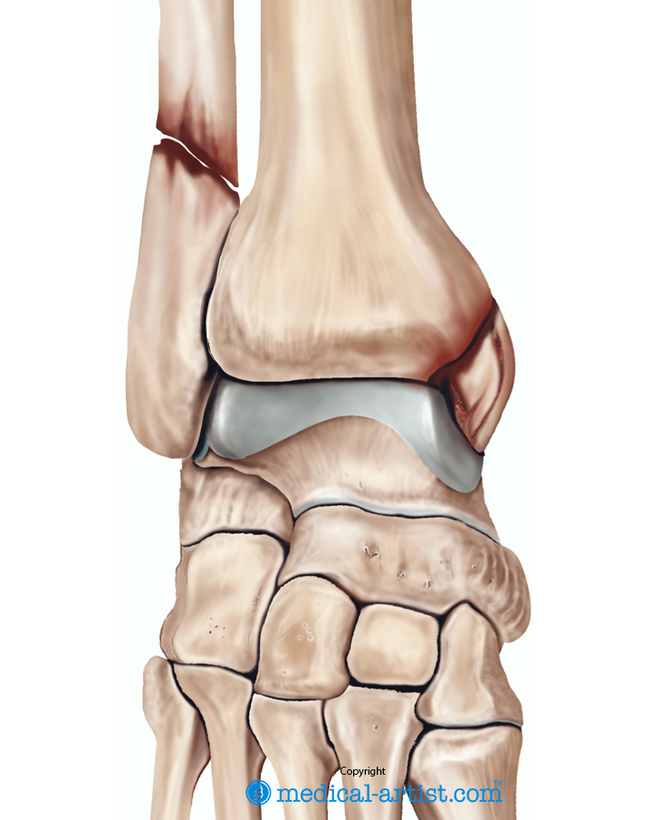Illustration showing fractures of both ankle bones.