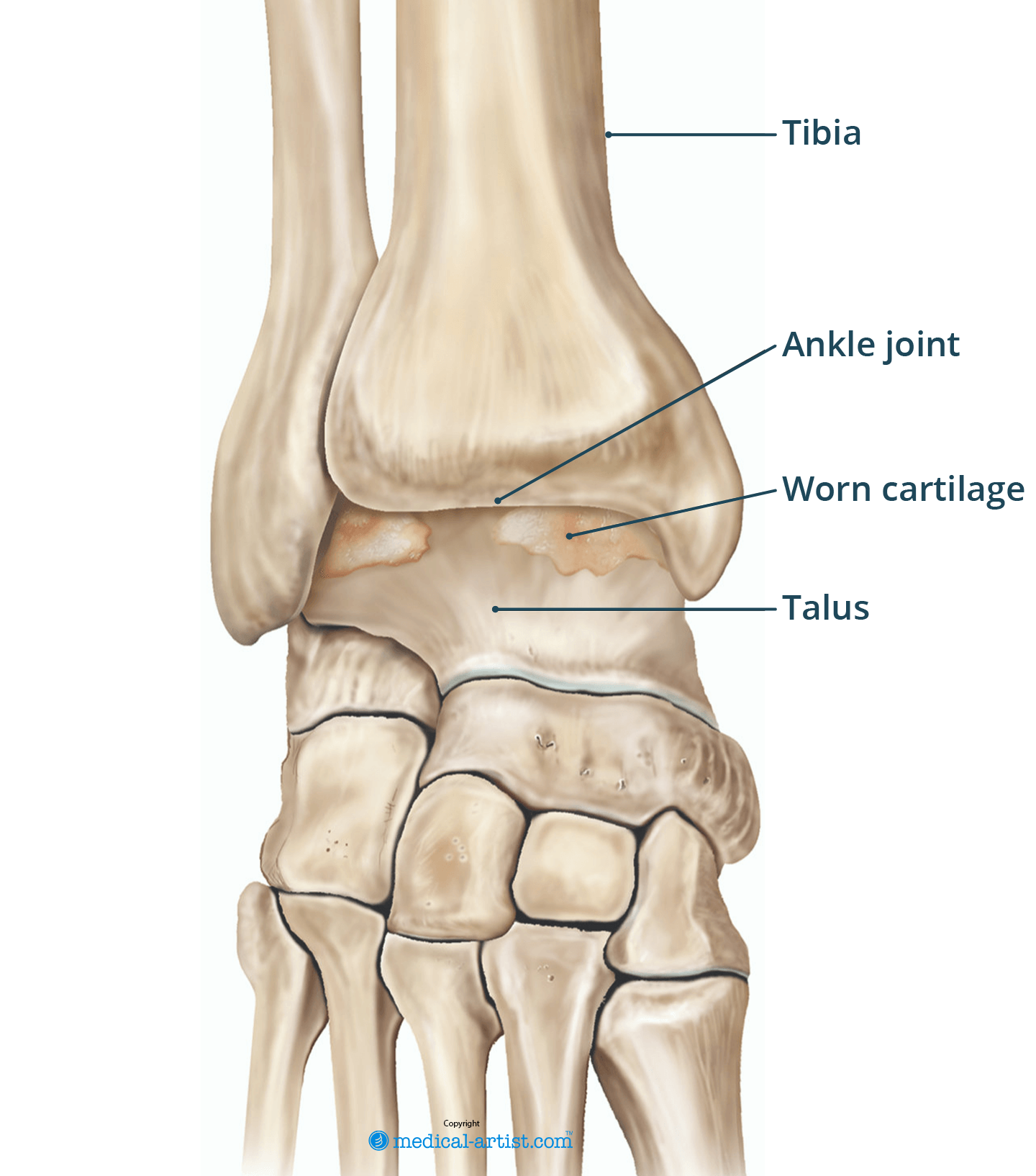 Illustration of an arthritic ankle.