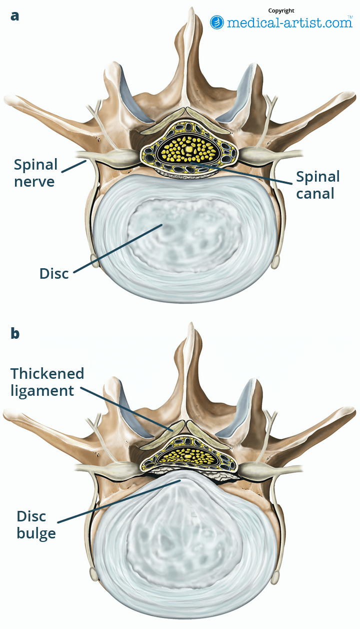 Illustration of a tear in the rotator cuff.