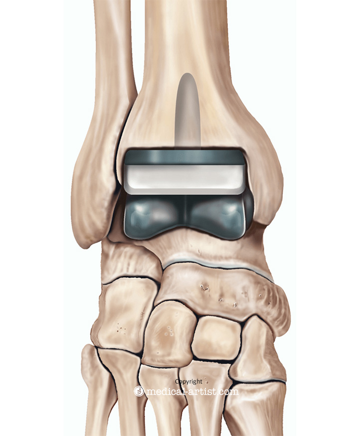 Illustration showing a total ankle replacement.