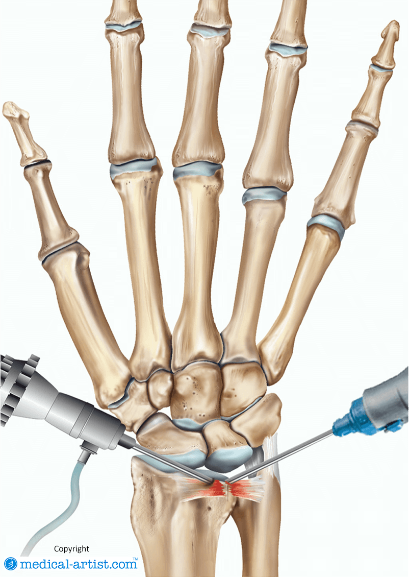 Illustration of an arthroscopy of the wrist.