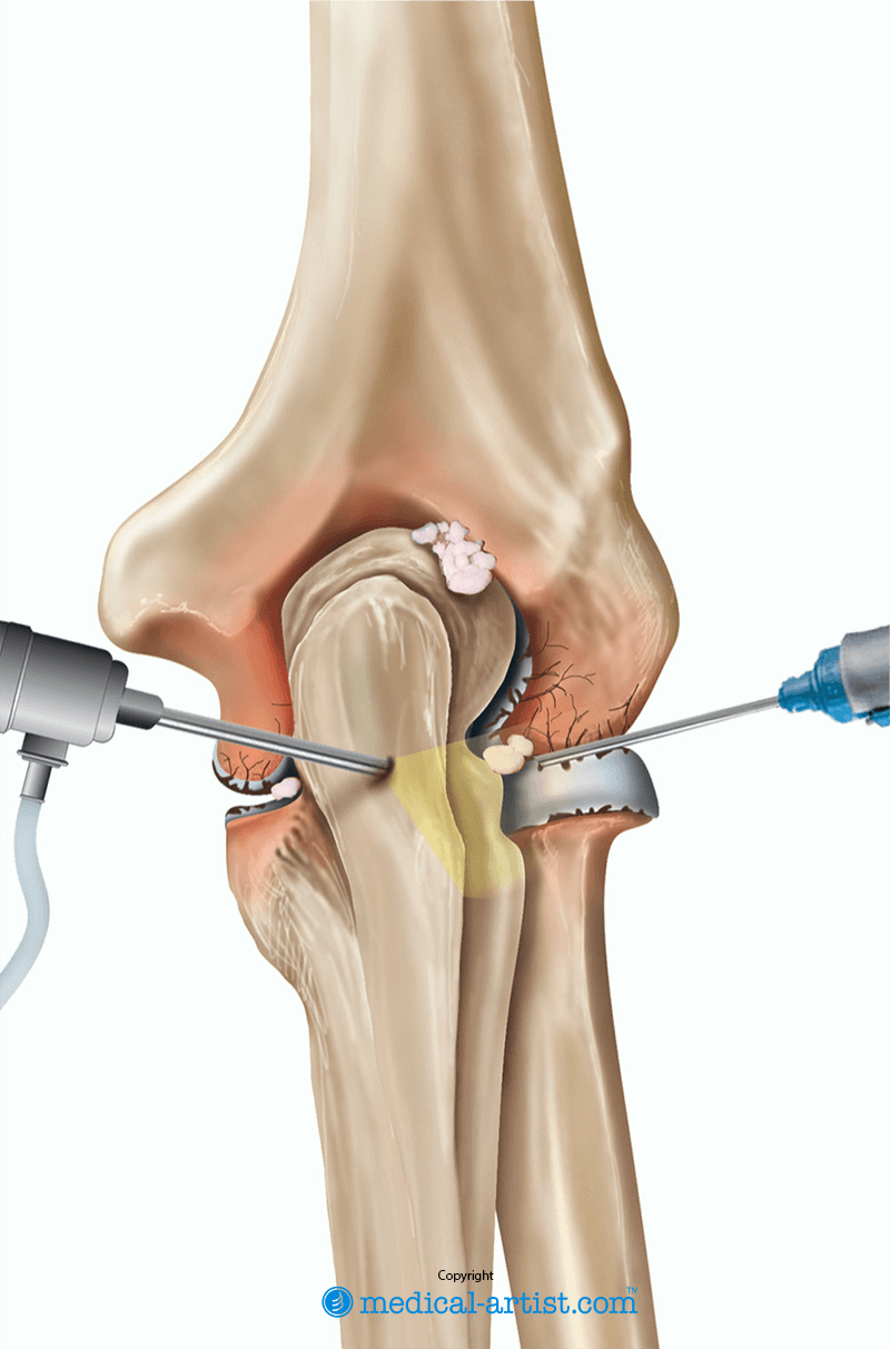 Illustration of an arthroscopy of the elbow.