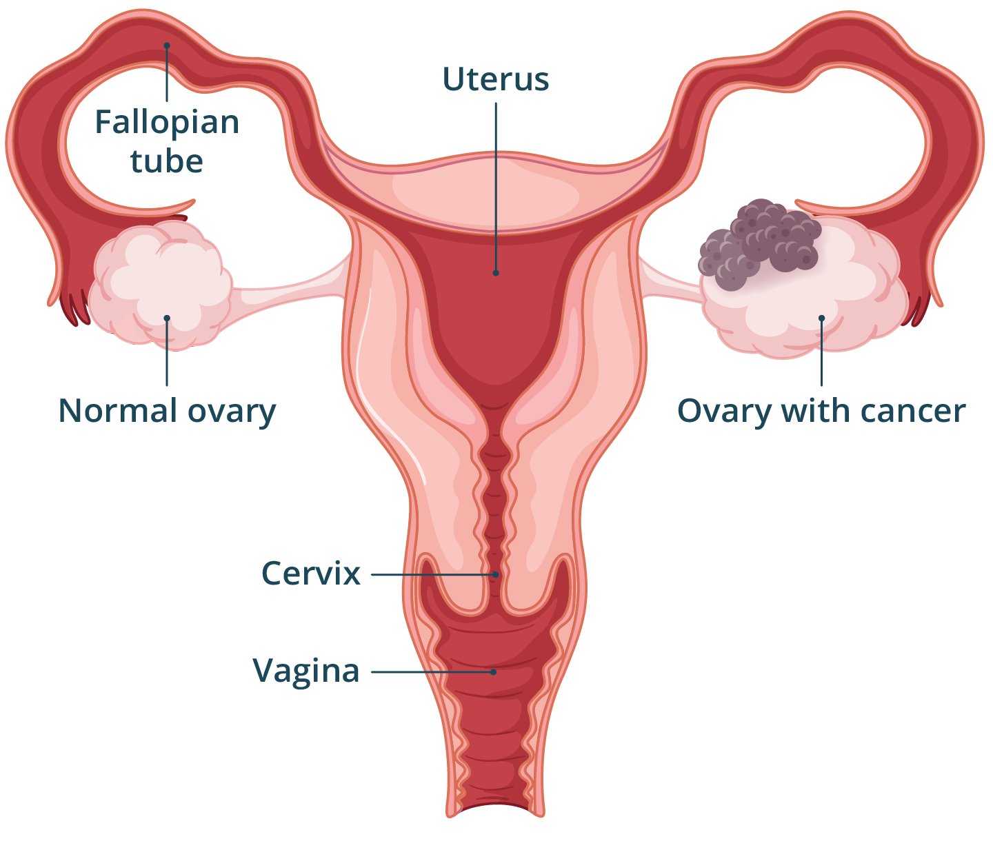 Illustration of the female reproductive system showing a normal ovary and an enlarged ovary with cancerous mass.