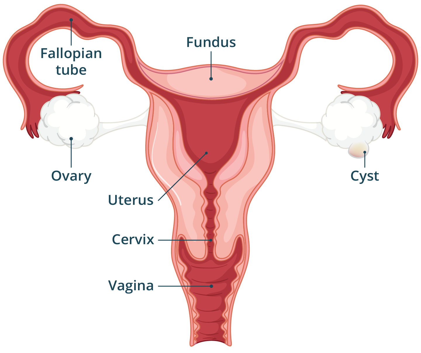 Illustration of the female reproductive system with a cyst forming on the ovary.