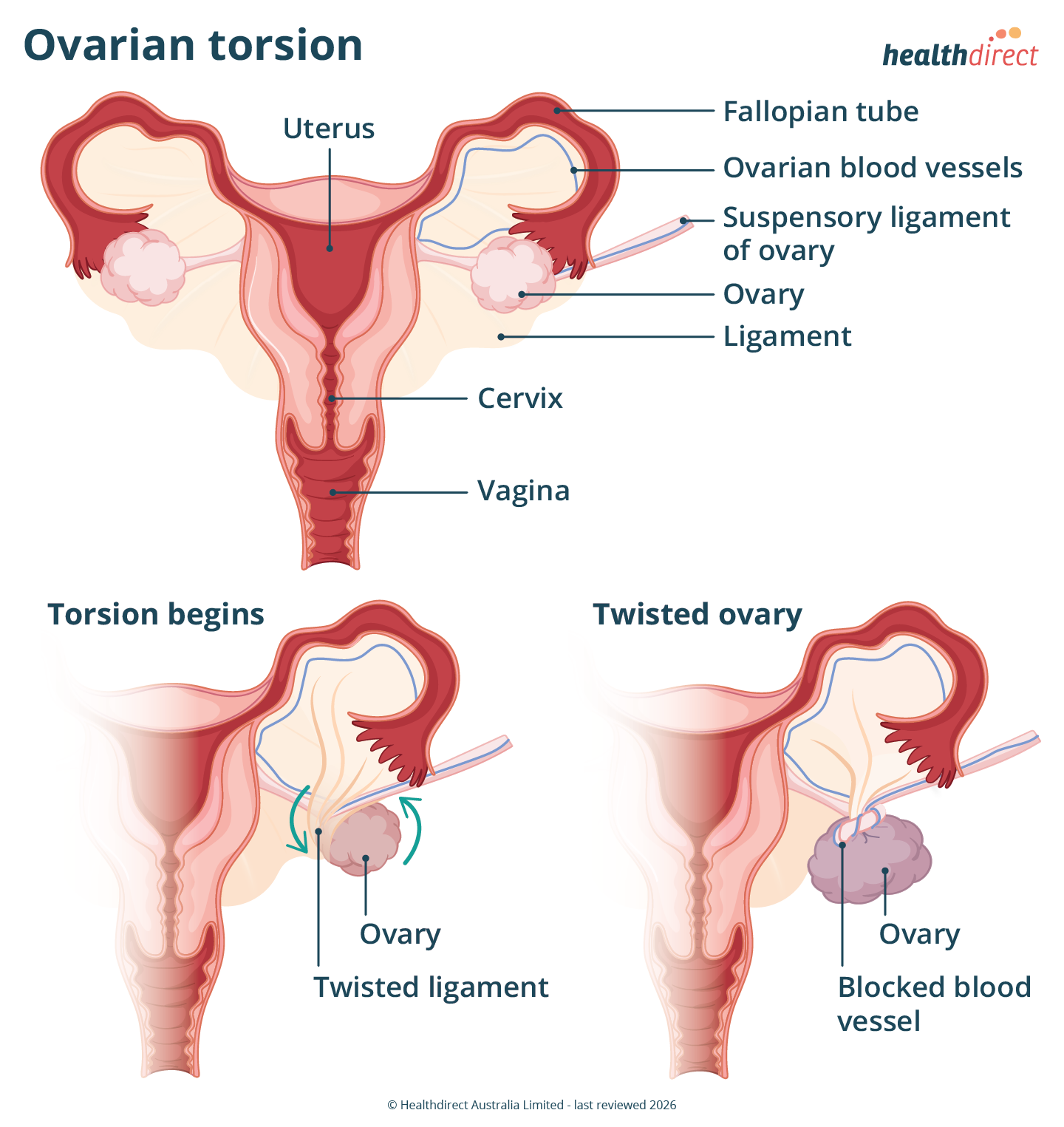 Illustration showing the stages of ovarian torsion, in which an ovary is twisting around the tissues that support it, cutting off blood flow.