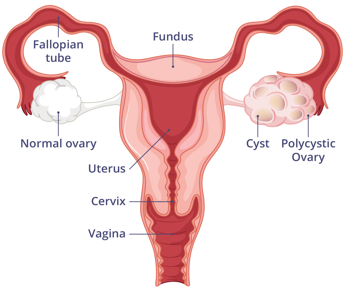 Illustration showing a normal ovary and a polycystic ovary.
