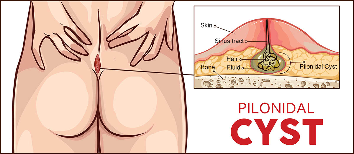 Pilonidal disease symptoms and treatment healthdirect