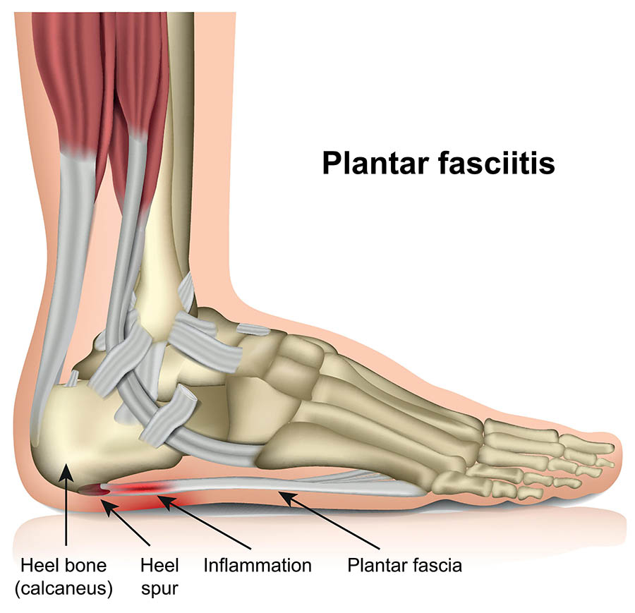Illustration showing plantar fasciitis.