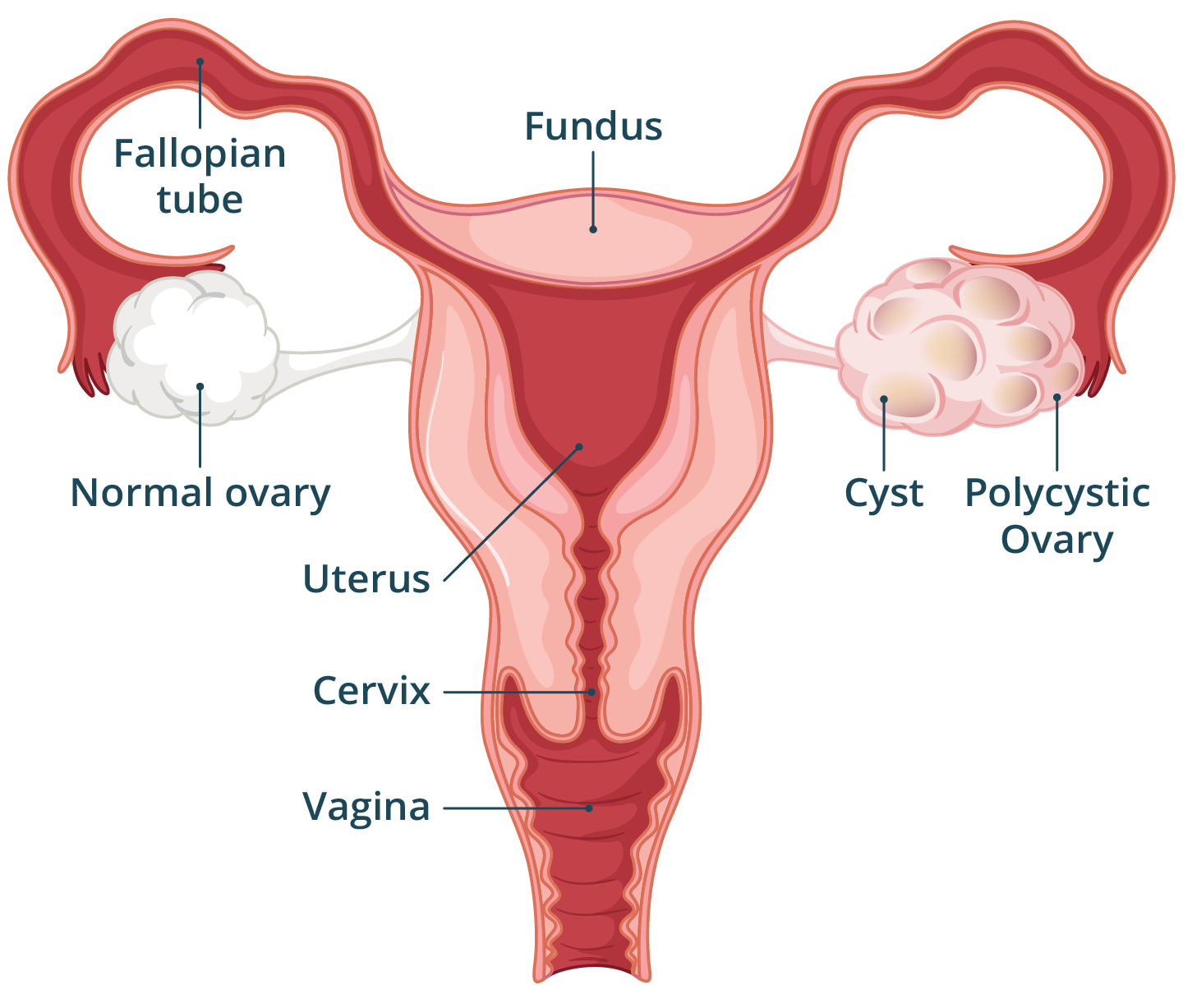 Illustration of the female reproductive system showing a normal ovary and an enlarged ovary with multiple fluid-filled sacs.