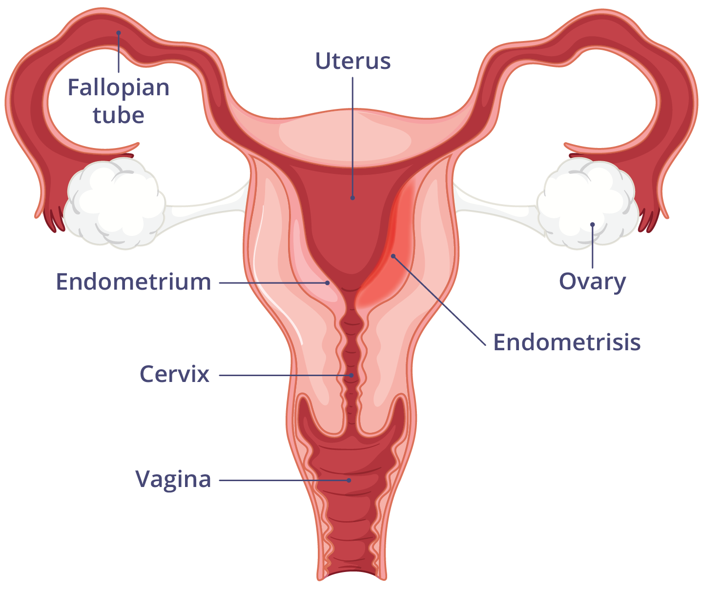 Illustration of the female reproductive system with postpartum endometritis - endometrium is inflamed and red.