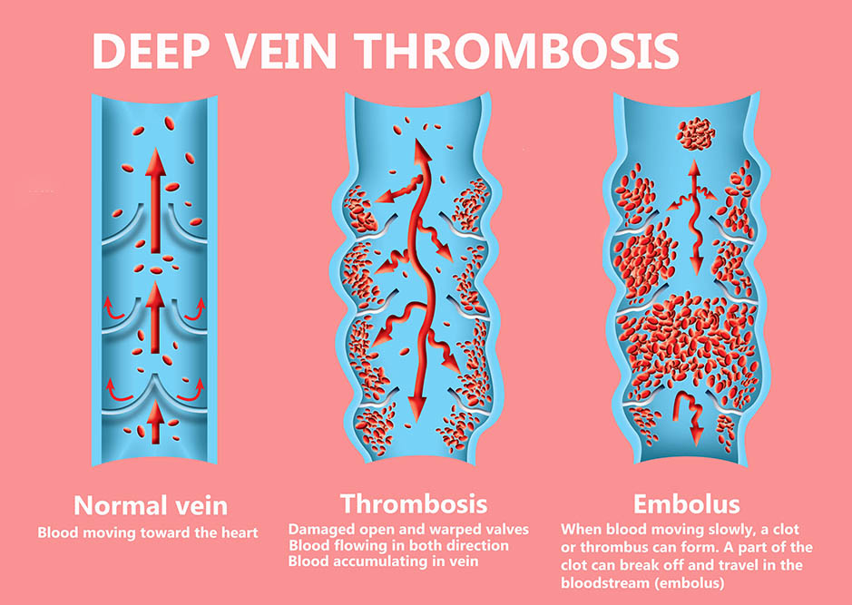 Pulmonary Embolism Causes Symptoms And Treatment Healthdirect