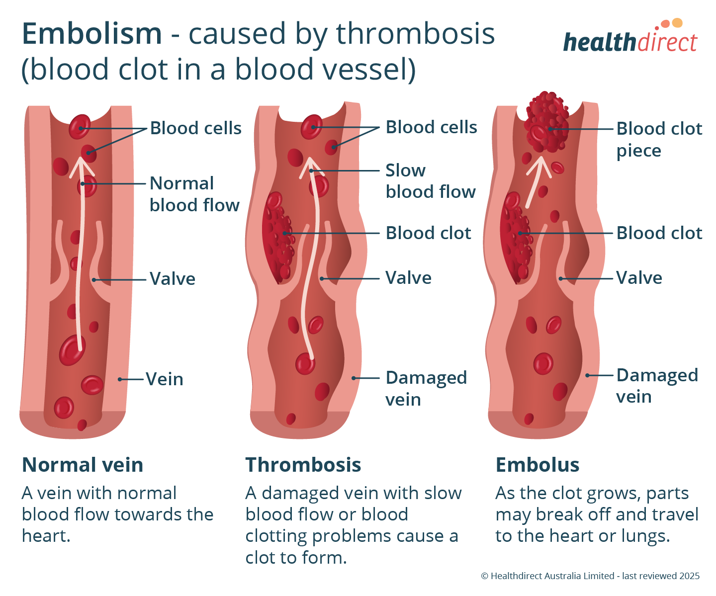 Illustration showing a normal vein in comparison to thrombosis and pulmonary embolism.