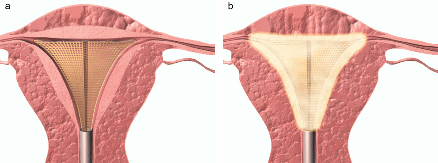 How Electric Is An Endometrial Ablation Performed Microwave
