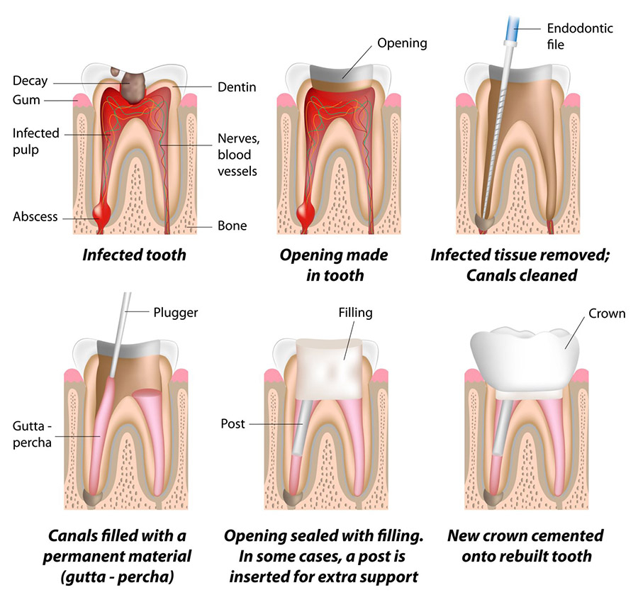 https://media.healthdirect.org.au/images/inline/original/root-canal-treatment-illustration-bd1a10.jpg?utm_source=chatgpt.com