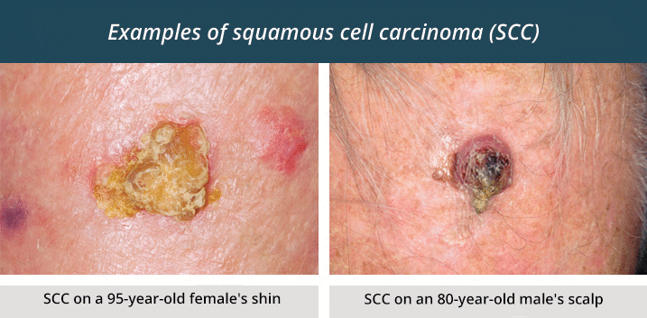 Squamous Cell Carcinoma On Leg