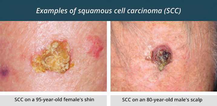 late squamous cell carcinoma