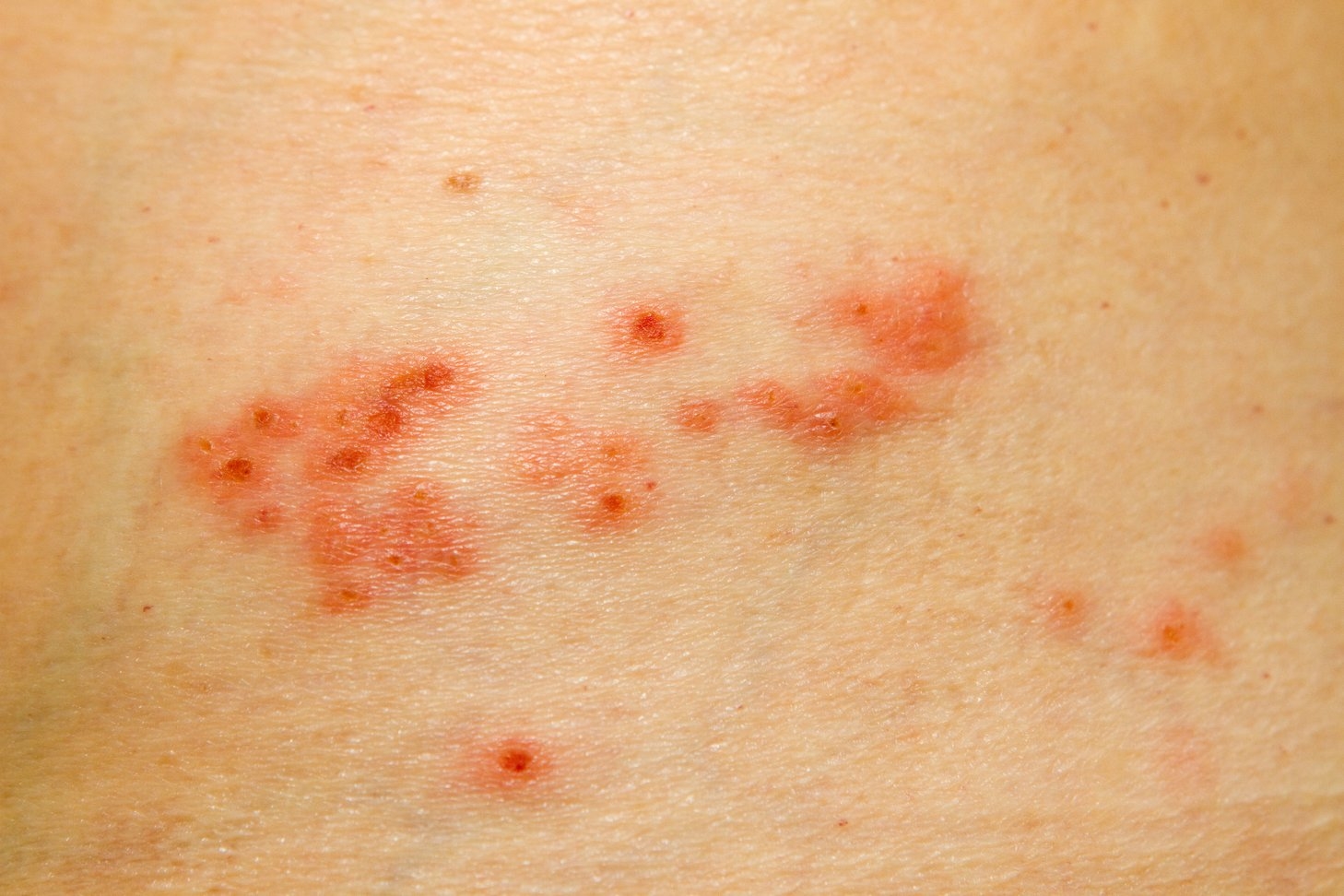 Shingles rash An image showing the side of a persons body that has a mild case of shingles rash. The rash consists of painful red bumps.